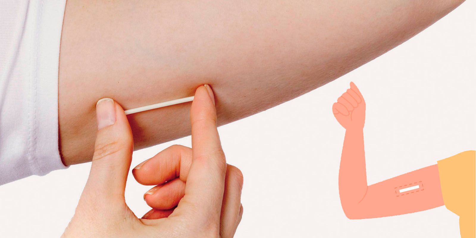 An image of a Contraceptive Implant